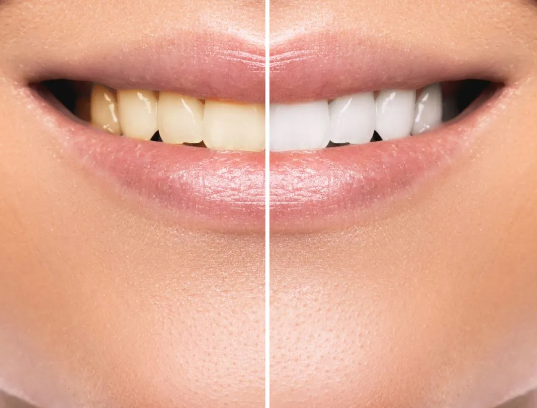 is it safe to whiten teeth?