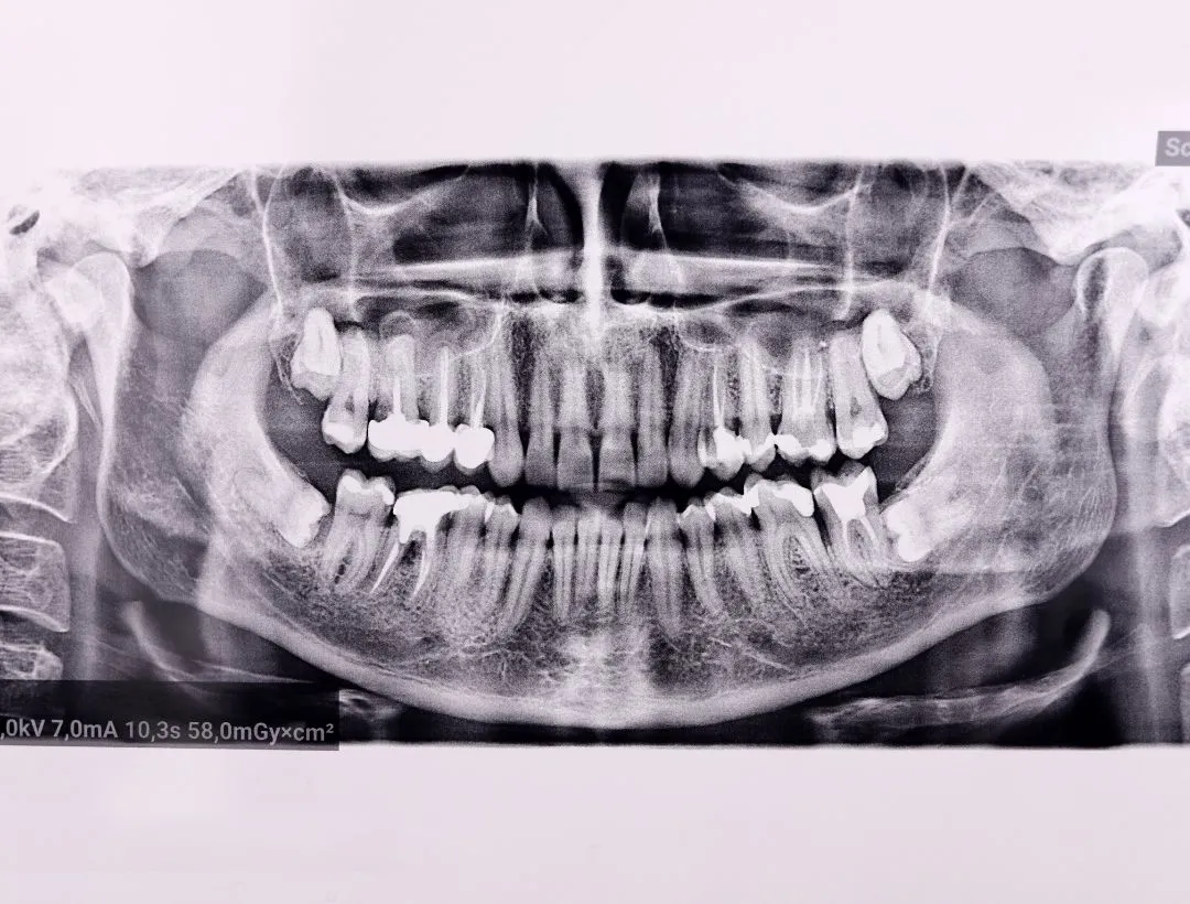 what to expect after dental bone graft surgery?