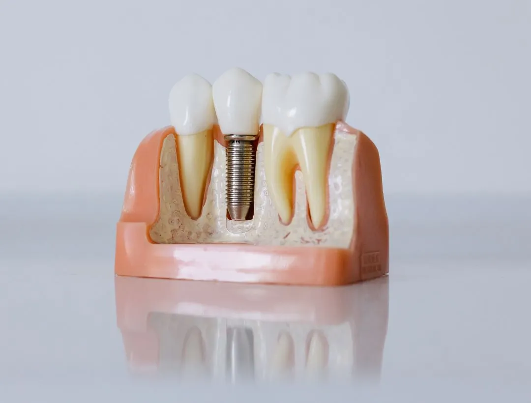 what you need to know about dental implants cleaning and maintenance