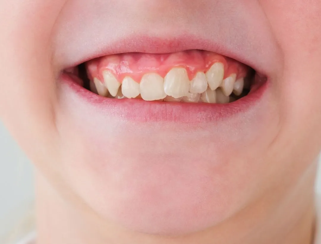 veneers vs braces which is right for fixing crooked teeth?
