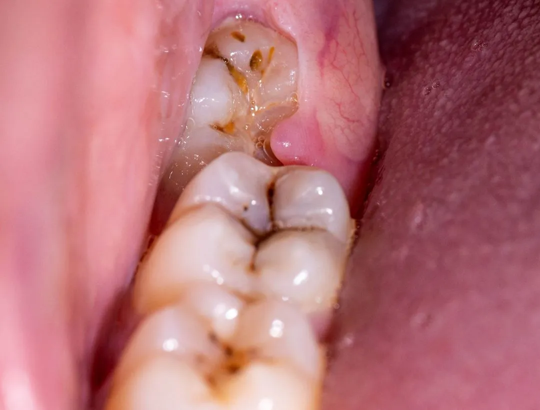 what to do after wisdom teeth removal