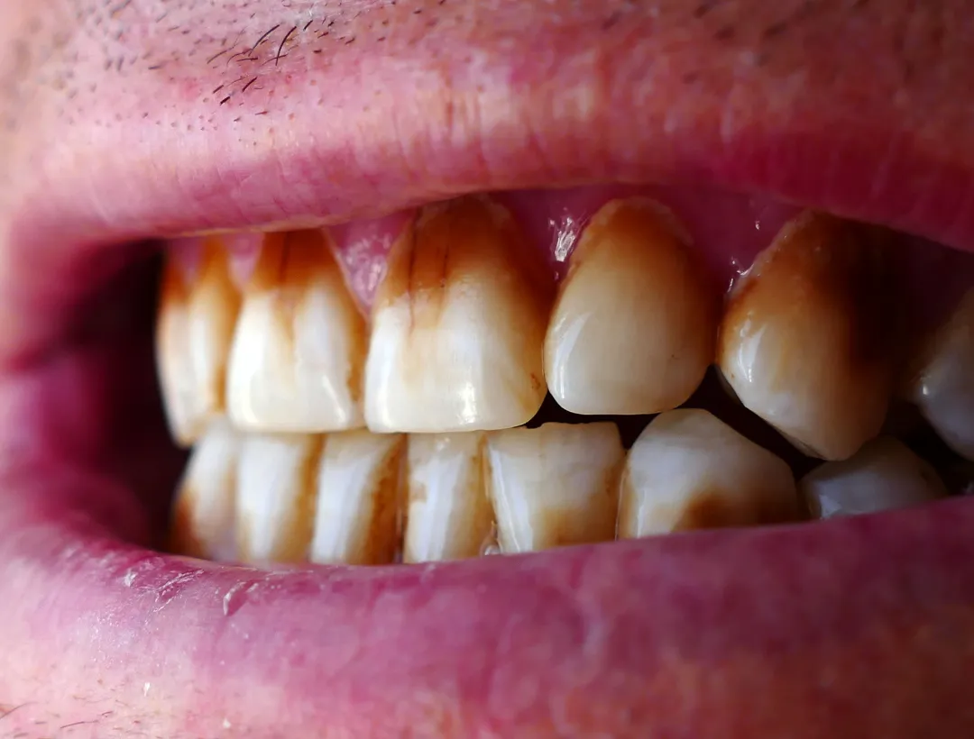 what causes a black gum line around the tooth?
