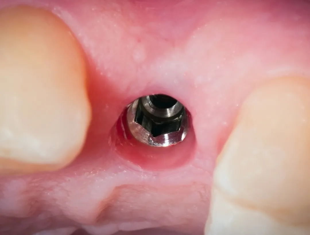 what to expect during a dental implant consultation?