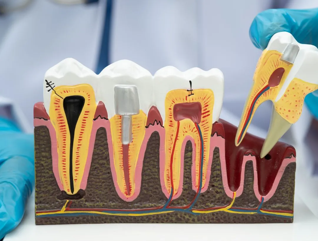 what are the signs that root canal therapy is needed
