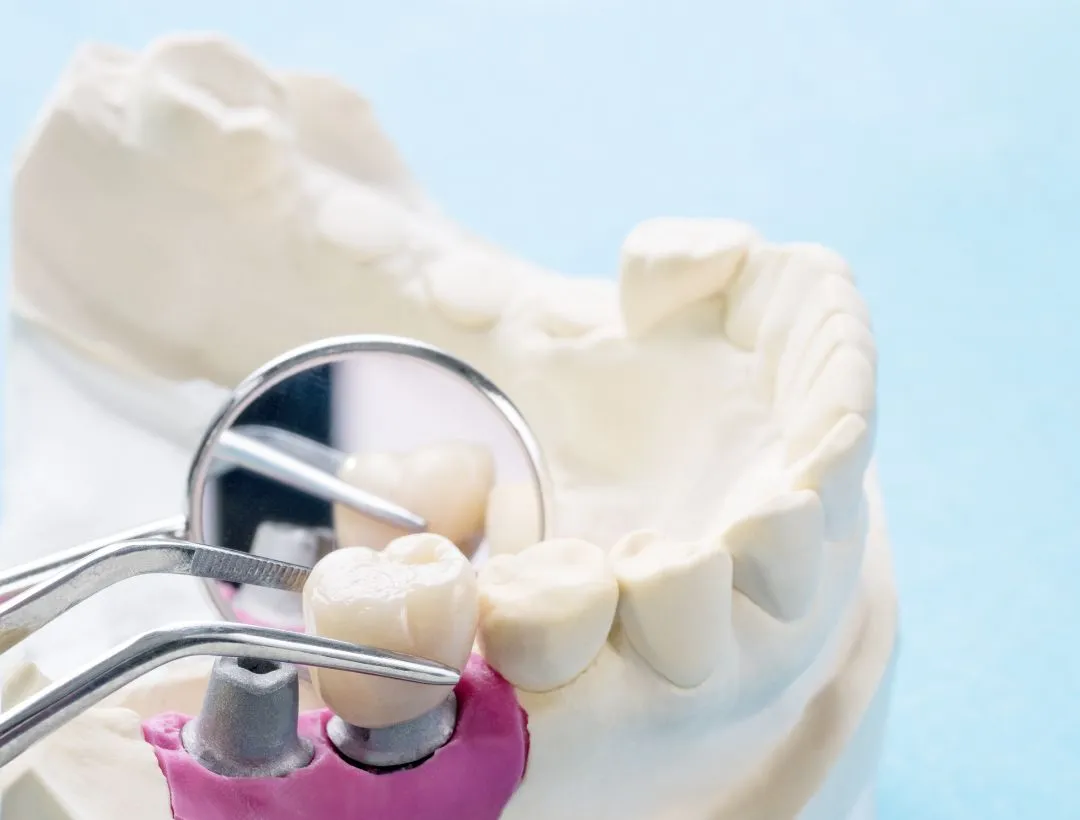 dental implants vs. bridges whats best for you