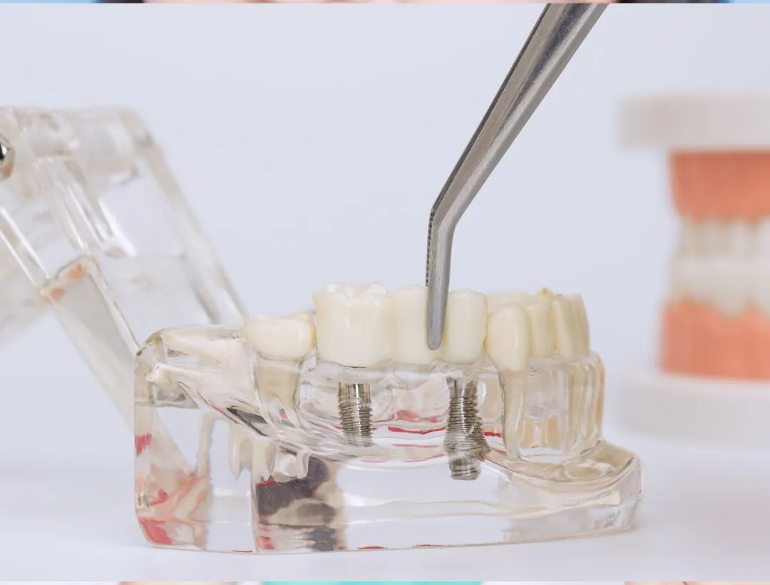 different types of dental implants