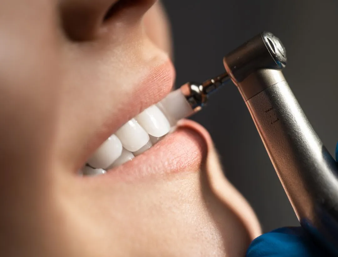 what’s the procedure for getting a dental veneer?