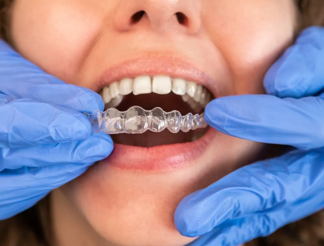 can invisalign fix an overbite?