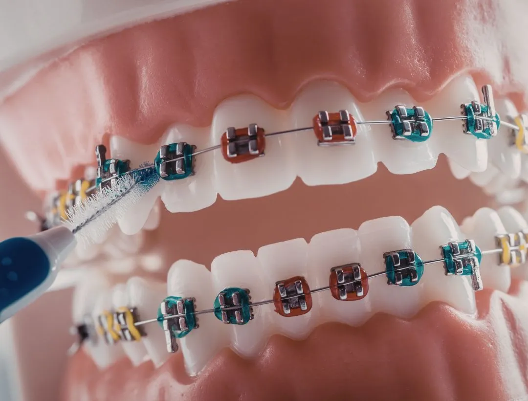 how to fix a crossbite with braces?