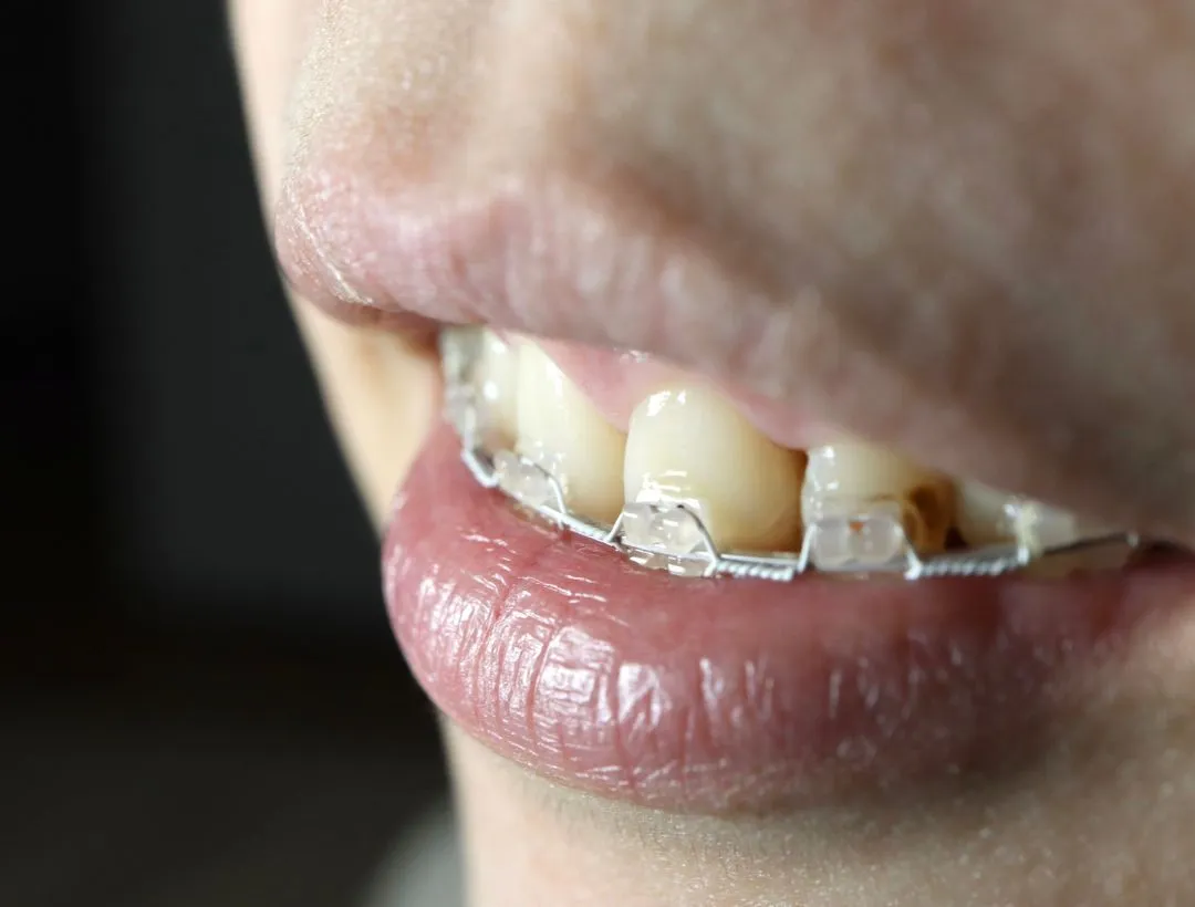 what you should know about full mouth reconstruction