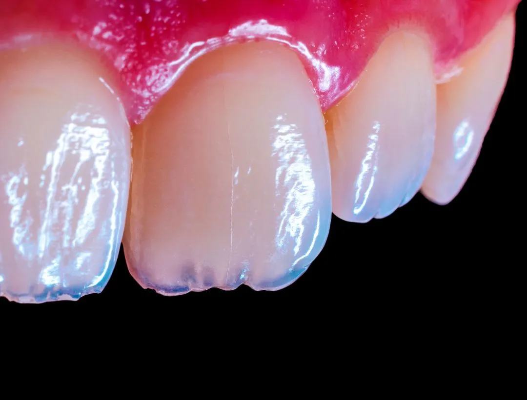 front tooth replacement options