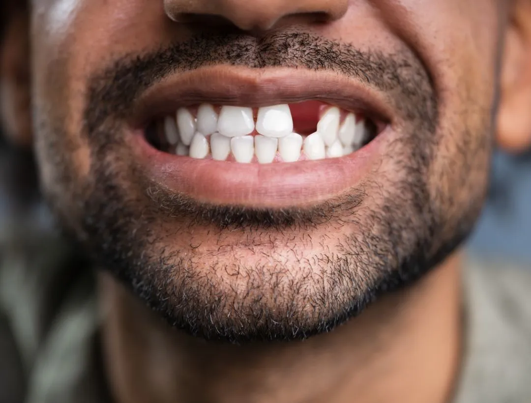 what is the cheapest way to replace missing teeth