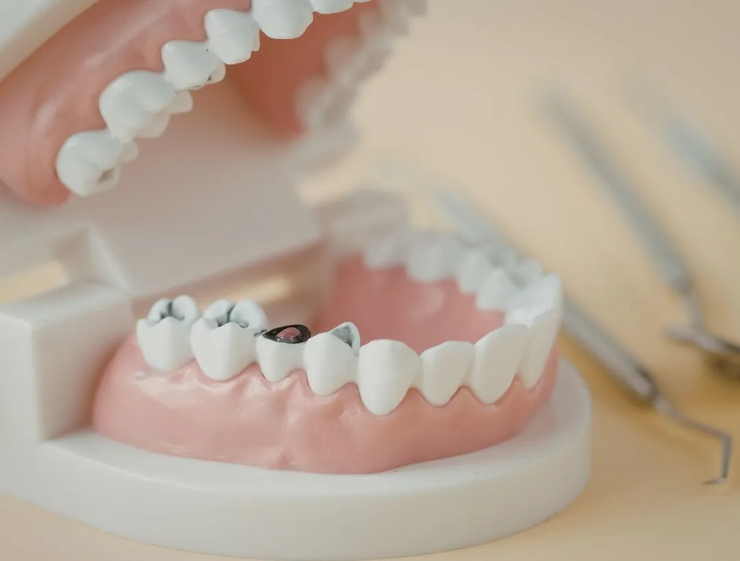 should i get a second opinion on dental implants?