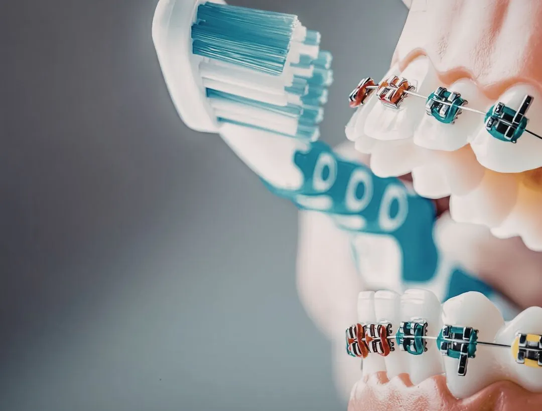 how to maintain good oral hygiene with braces