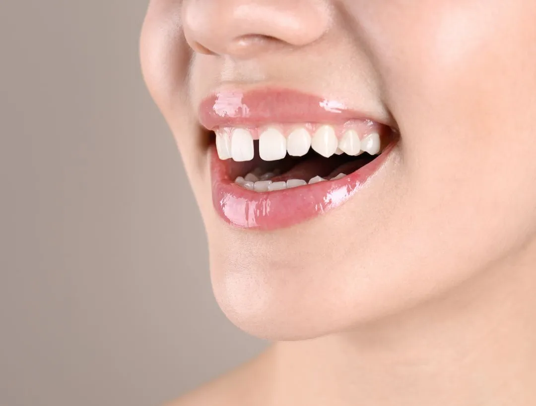 how to fix a gap in the teeth