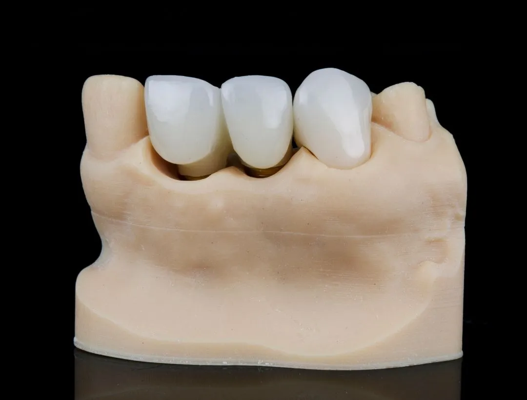 signs that your dental crown needs to be replaced