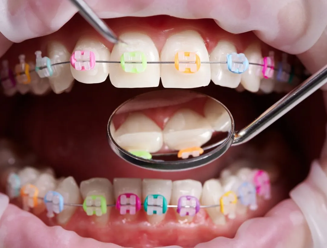 can you switch orthodontists when you have braces?