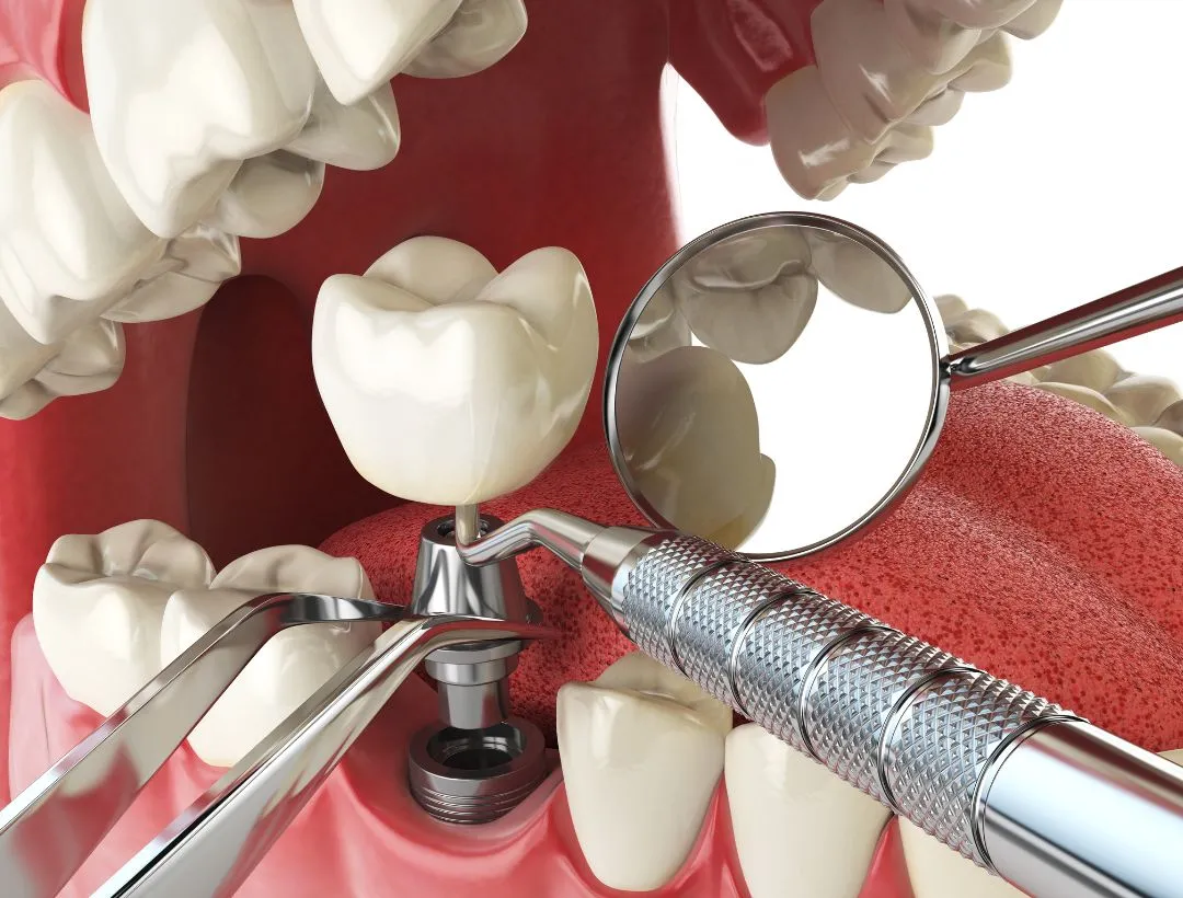 can you do bone grafting and dental implant at the same time?