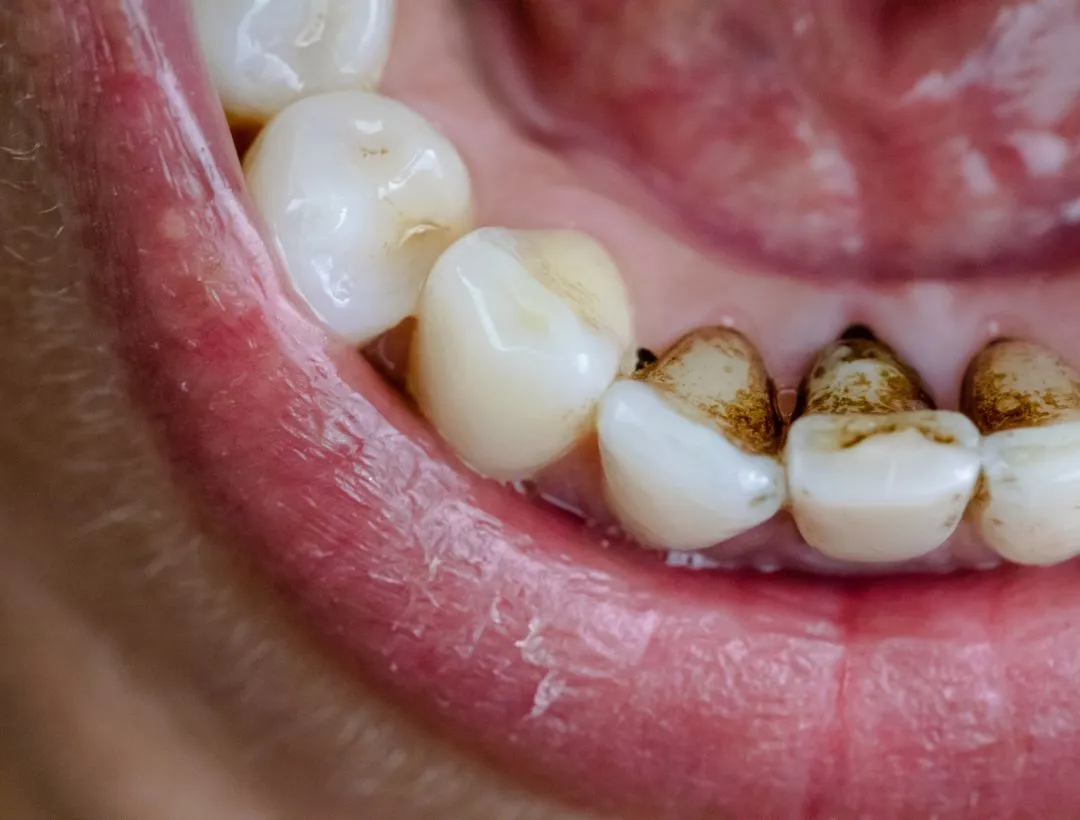 what it means if your tooth broke off and it’s black inside