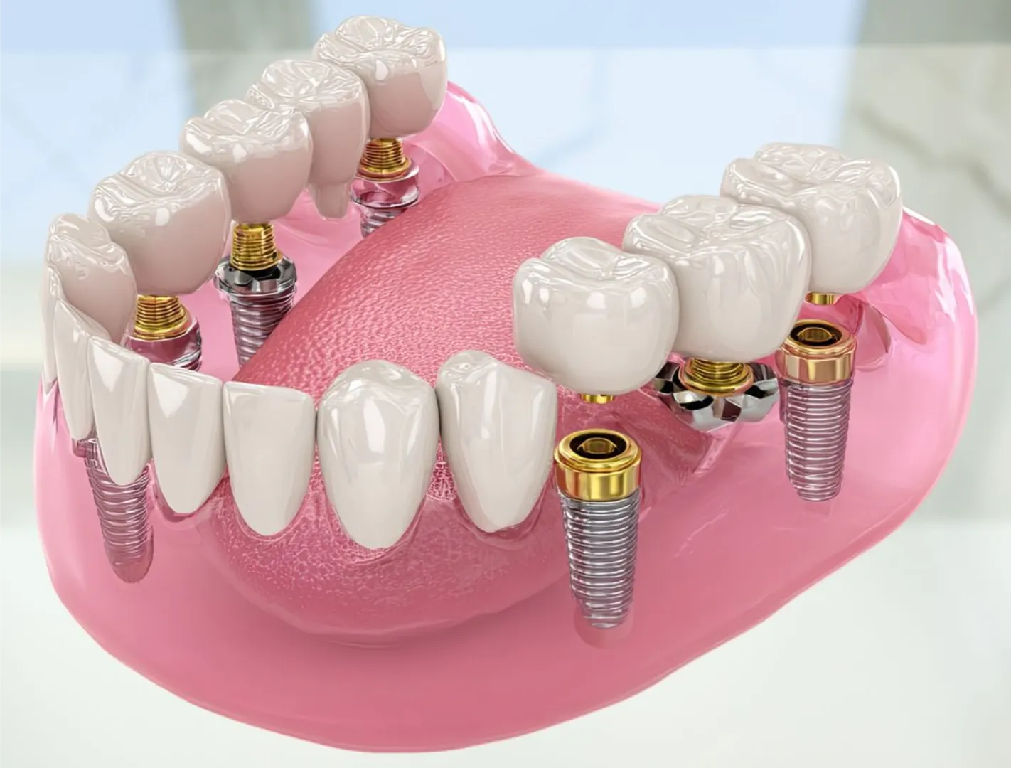 why choose dental implants over dentures?
