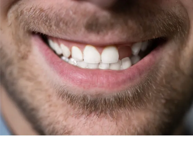 single dental implant for a missing side tooth