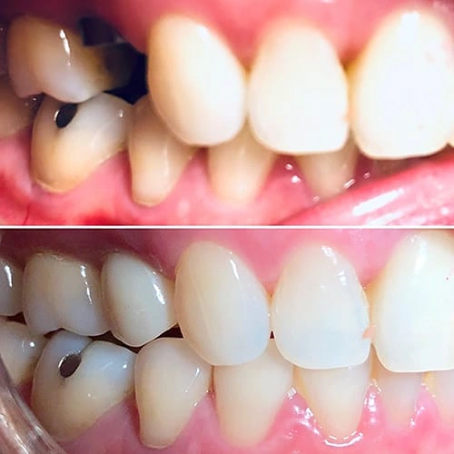 getting dental implant