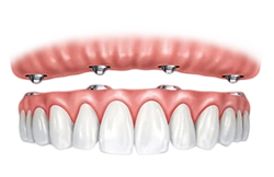 all on four implants