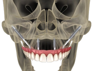 zygomatic implants