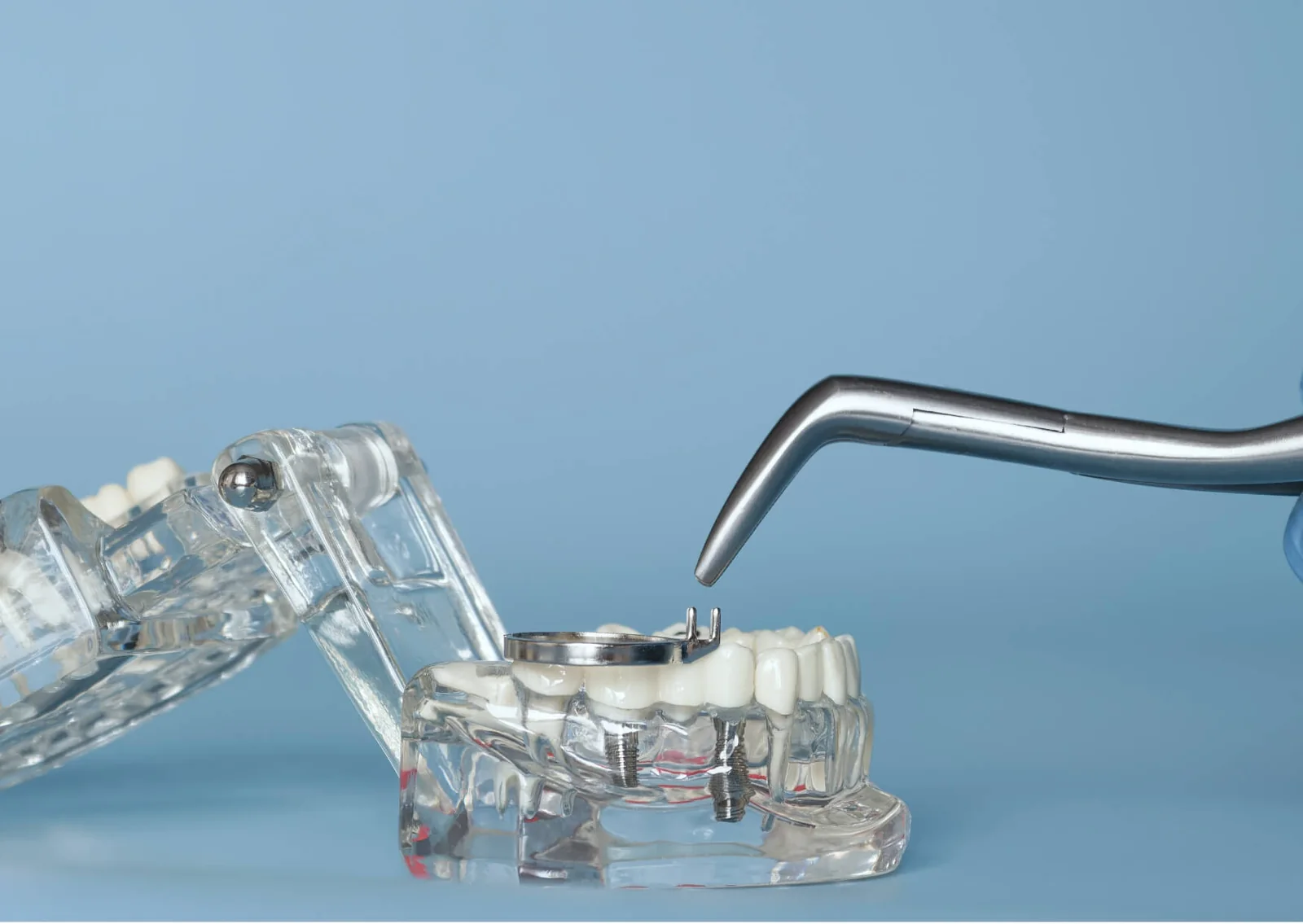 Dental implant model with a restoration removed, illustrating the components involved in a dental implant removal procedure.