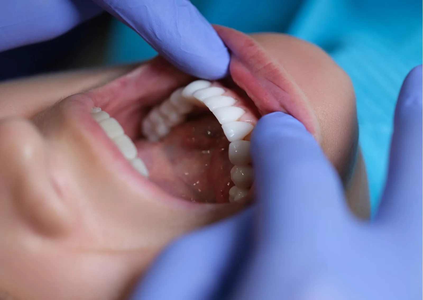 Close-up of porcelain veneers on front teeth during a dental checkup, highlighting their appearance and long-term durability.