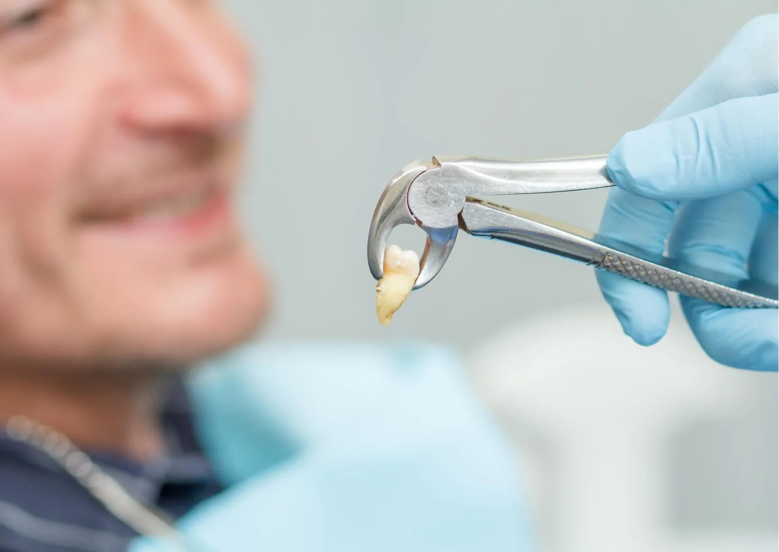 Recently extracted tooth held with dental forceps, illustrating a completed tooth extraction procedure and what is removed during treatment.