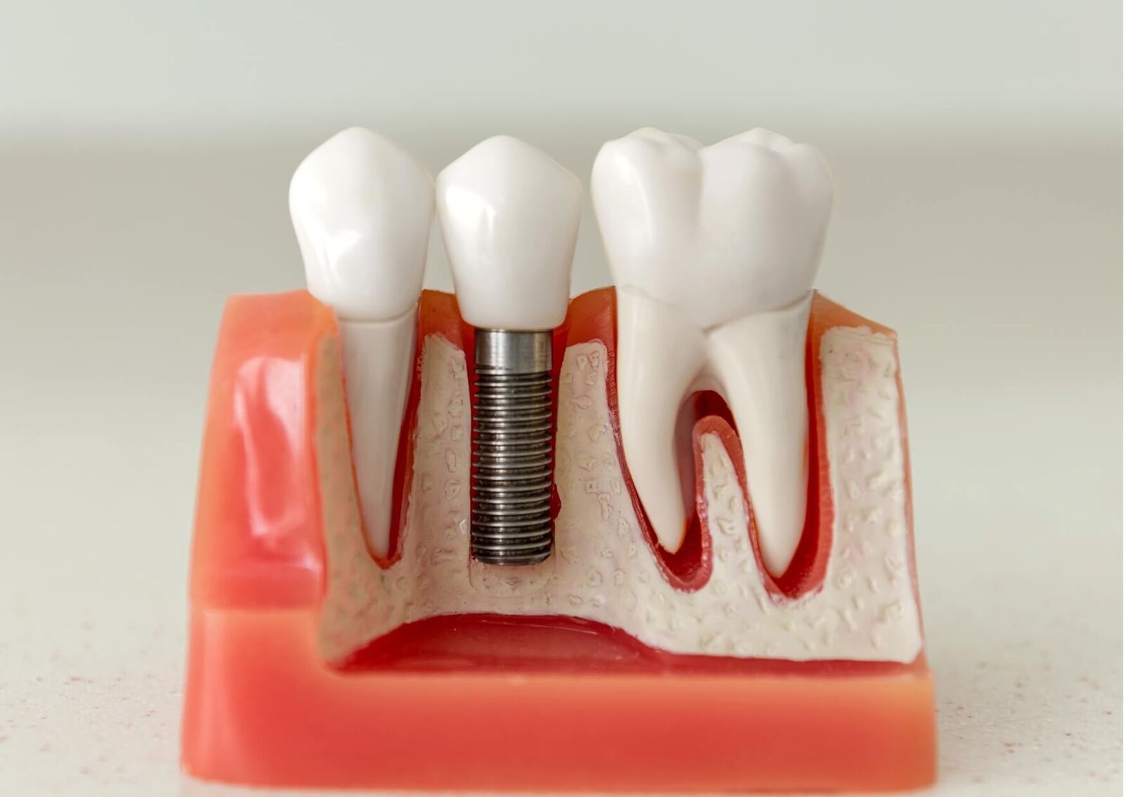 Dental implant model showing an implant-supported crown alongside natural teeth, illustrating components that contribute to dental implant costs.