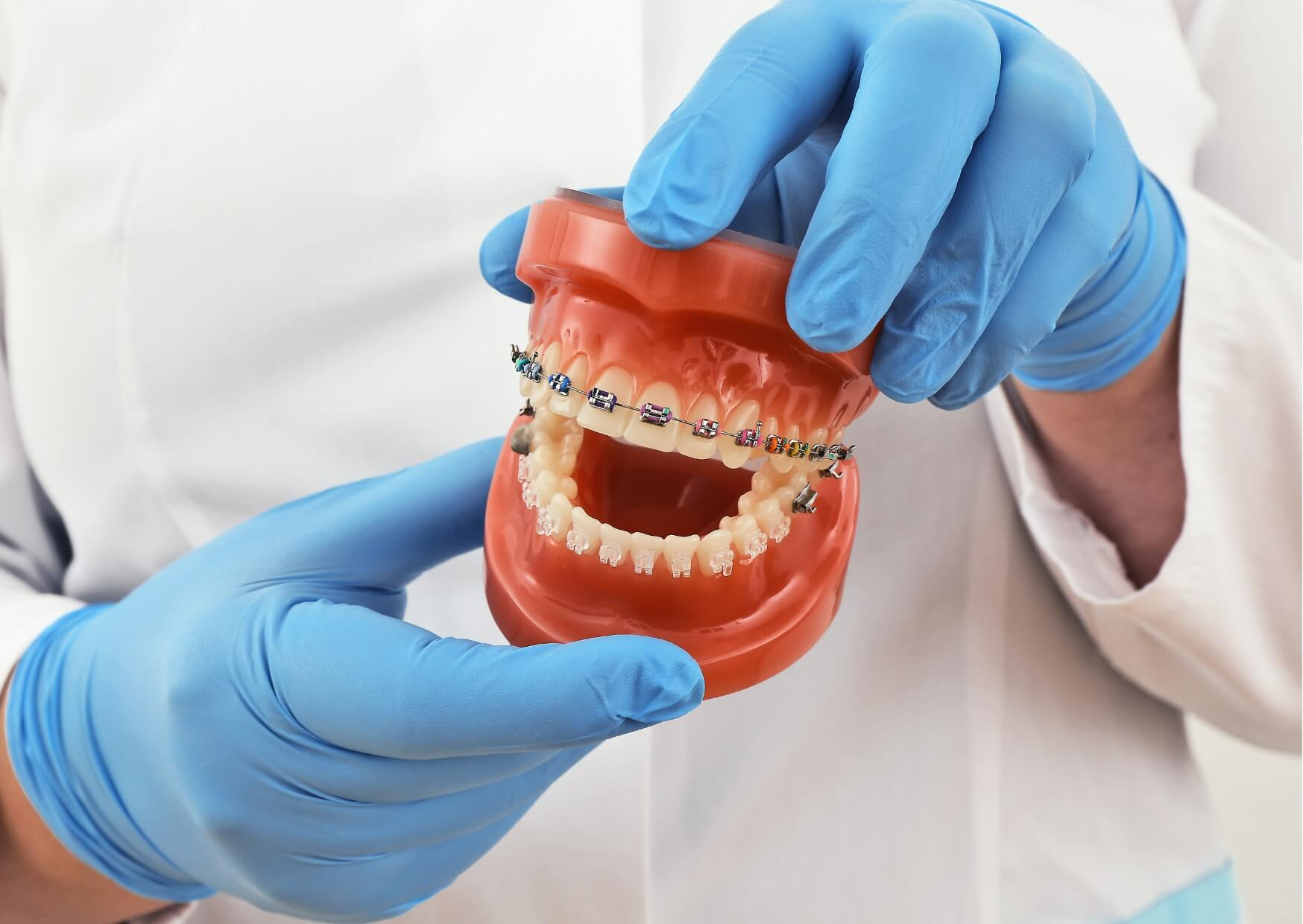 Orthodontic model demonstrating braces and common foods to avoid, including candy that can damage brackets and wires.
