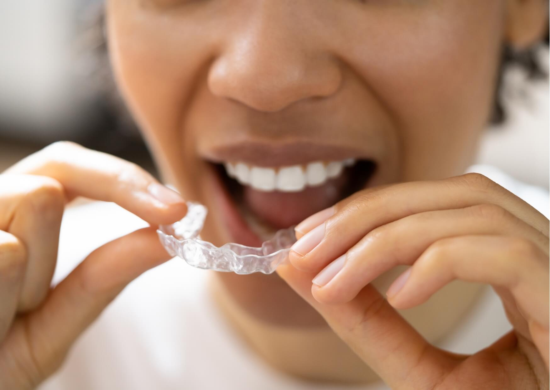 Person inserting a custom clear nightguard to help prevent teeth grinding, jaw clenching, and nighttime tooth wear.